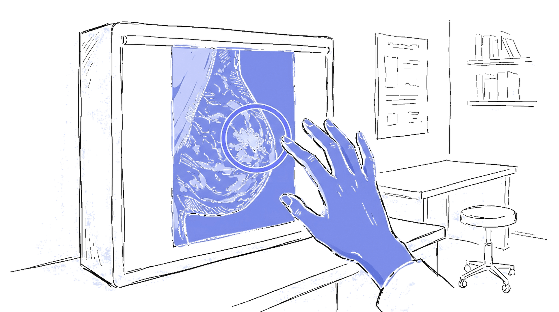 Handgezeichnete Skizze eines Mammogramms mit KI-Overlay-Markierung